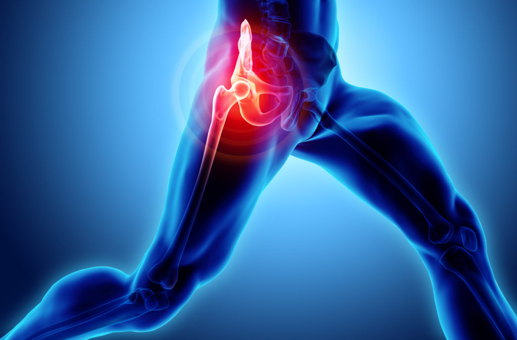 3D illustration, hip painful skeleton x-ray, medical concept.