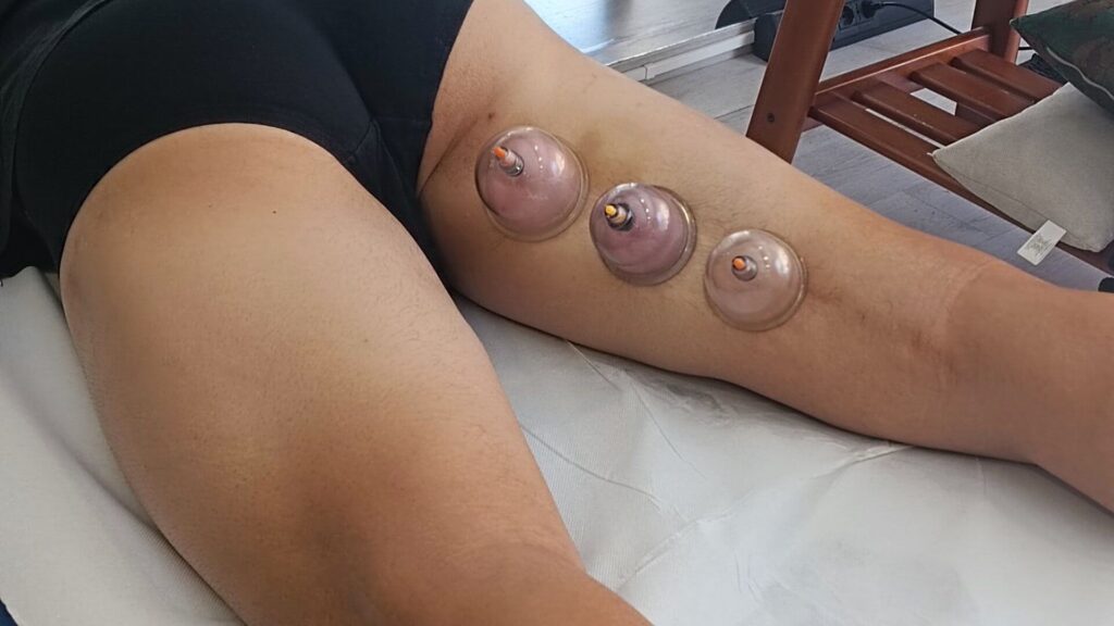 Fisioterapia sportiva - coppettazione