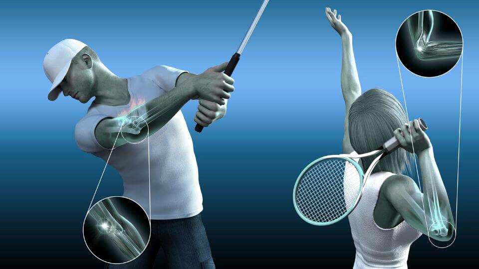Gomito del tennista